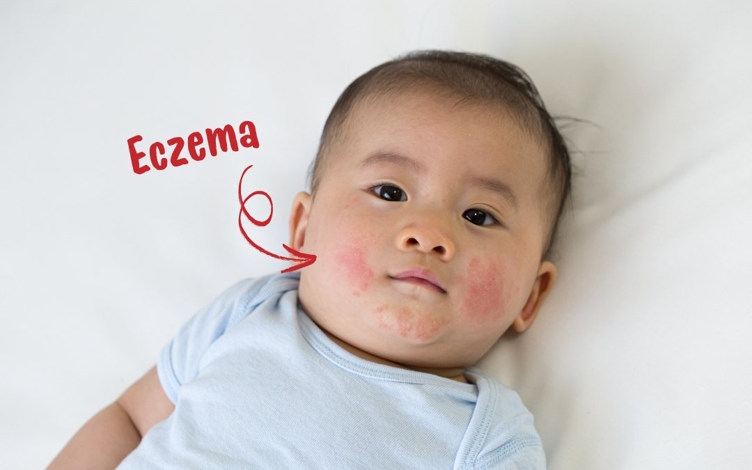 G-NIIB SIM03_Eczema Baby Post Covid